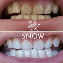 Load image into Gallery viewer, SNOW Teeth Whitening + 6-Month Toothpaste Bundle