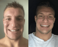 Load image into Gallery viewer, SNOW TEETH WHITENING™ SYSTÈME À DOMICILE [KIT TOUT-EN-UN]
