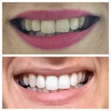 Load image into Gallery viewer, Floyd Mayweather's Snow Teeth Whitening™ At-Home System [All-in-One Kit]
