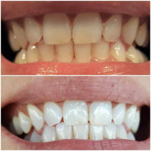 Load image into Gallery viewer, Floyd Mayweather's Snow Teeth Whitening™ At-Home System [All-in-One Kit]
